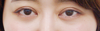 下眼瞼脱脂の症例写真（術後）