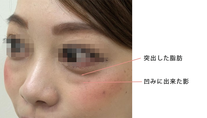 下眼瞼脱脂 目の下の脂肪取り の整形について 美容整形 美容外科なら水の森美容外科 公式 総合サイト