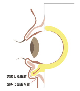 まぶた・目の下に膨らみがある人の目周りの断面図