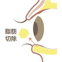 下眼瞼脱脂施術手順2