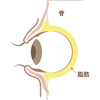 下眼瞼脱脂施術手順3
