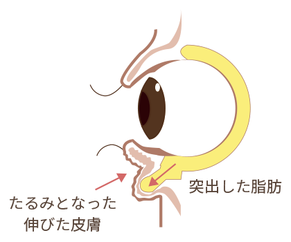 下眼瞼脱脂 目の下の脂肪取り の整形について 美容整形 美容外科なら水の森美容外科 公式 総合サイト 下眼瞼脱脂 目の下の脂肪取り の整形について 美容整形 美容外科なら水の森美容外科 公式 総合サイト