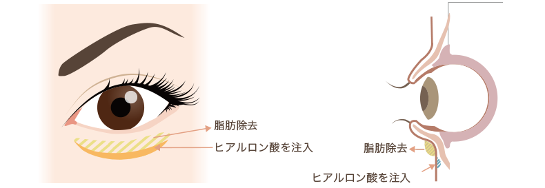 目の下の脂肪除去とヒアルロン酸注入の図