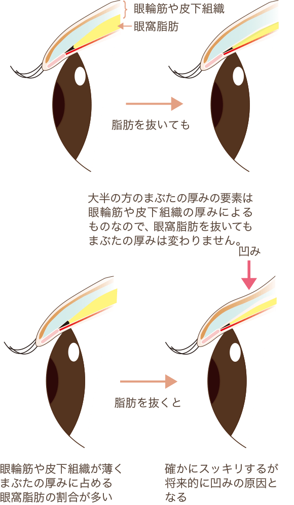 目の上脂肪除去の注意点