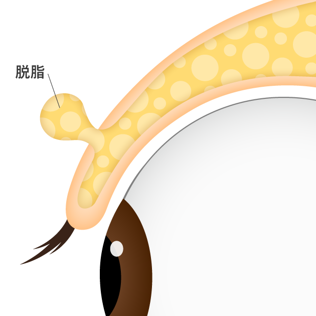 まぶた・目の上脱脂術の手術方法