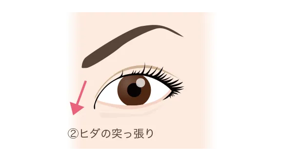 蒙古ひだがある場合の二重ライン