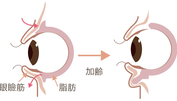 加齢により眼球周りの脂肪が下がってきた図