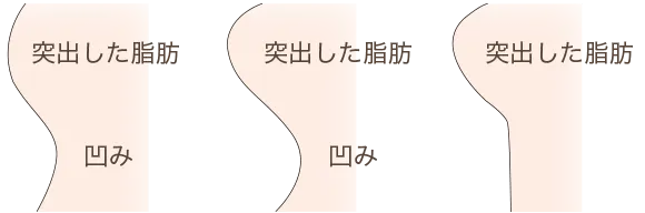 横から見る目の下の凹み3タイプ