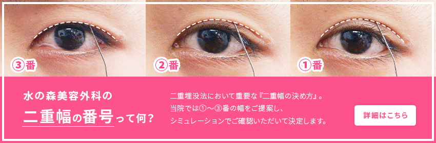 埋没法による二重まぶた整形 目 二重整形 美容整形なら水の森美容外科 公式 総合サイト 埋没法による二重まぶた整形 目 二重整形 美容整形なら水の森美容外科 公式 総合サイト