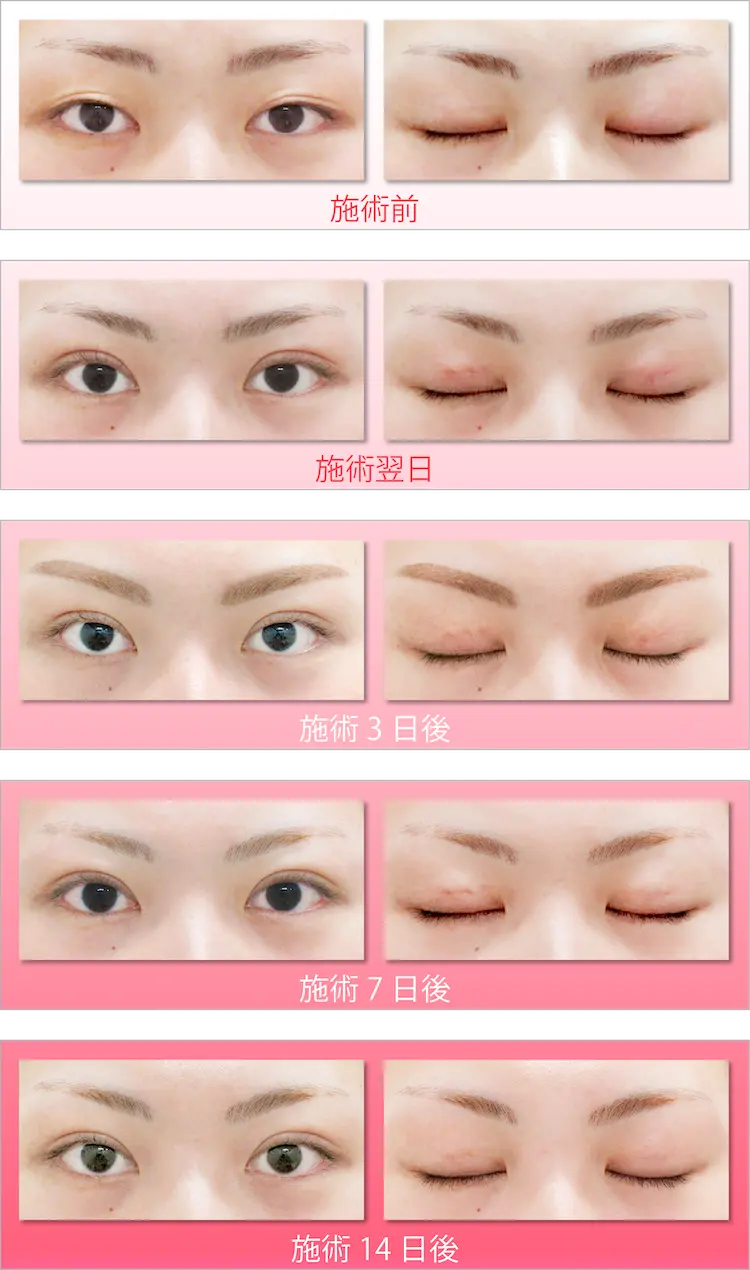 二重埋没法 二重 目元の整形なら水の森美容クリニック 公式 総合サイト