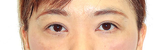 目頭切開と二重整形をされた患者様の症例写真(術後)1
