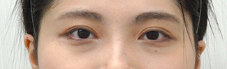 目頭切開と二重整形をされた患者様の症例写真（術後）2