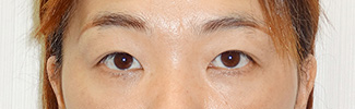 目頭切開と二重整形をされた患者様の症例写真(術前)1