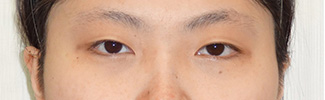 目頭切開と二重整形をされた患者様の症例写真(術前)2