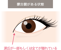 目頭切開 目 二重 美容整形 美容外科なら水の森美容外科 公式 総合サイト 目頭切開 目 二重 美容整形 美容外科なら水の森美容外科 公式 総合サイト
