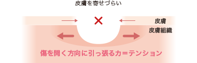 アンダーマイン(皮膚剥離)説明図1