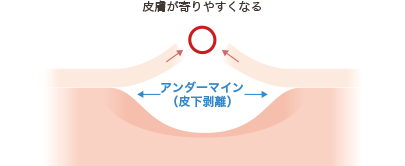 アンダーマイン(皮膚剥離)説明図2