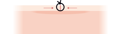 アンダーマイン（皮膚剥離）説明図3