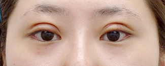 二重全切開法 二重まぶた 目元の整形なら水の森美容外科