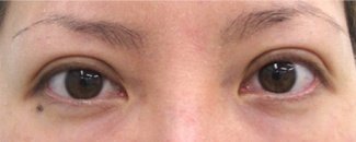 二重手術 切開法 の整形について 美容整形 美容外科なら水の森美容外科 公式 総合サイト