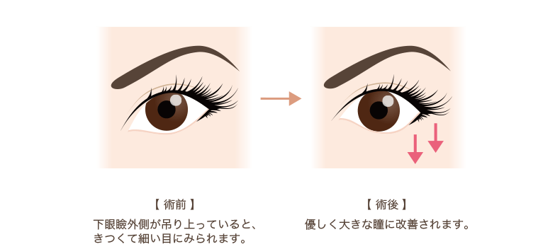下眼瞼下制術（たれ目形成）の手術方法