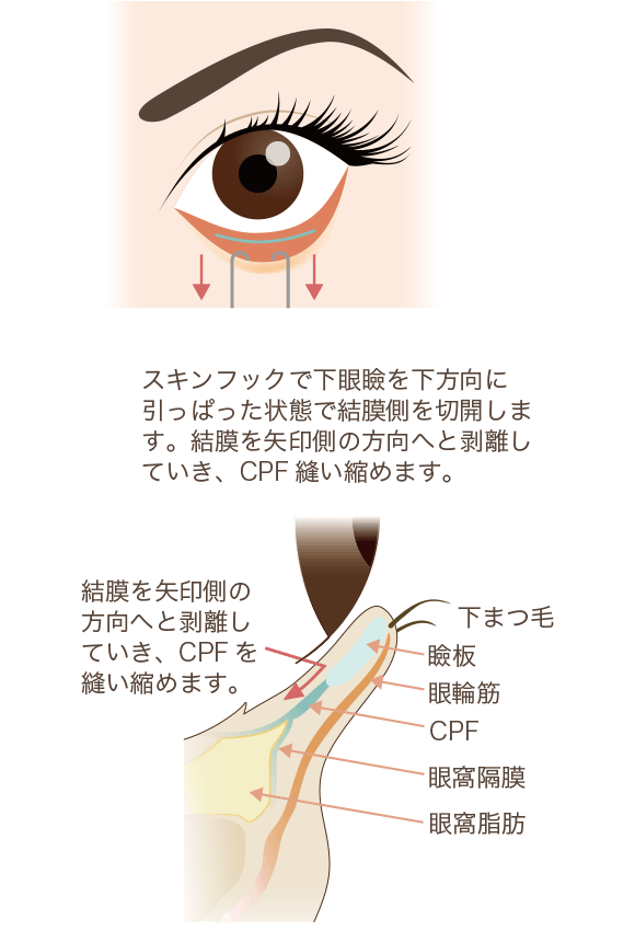 下眼瞼下制術 たれ目形成 の整形について 目 二重 整形 美容整形なら水の森美容外科 公式 総合サイト