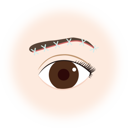 眉下切開 眉下リフト 美容整形 美容外科なら水の森美容外科 公式 総合サイト