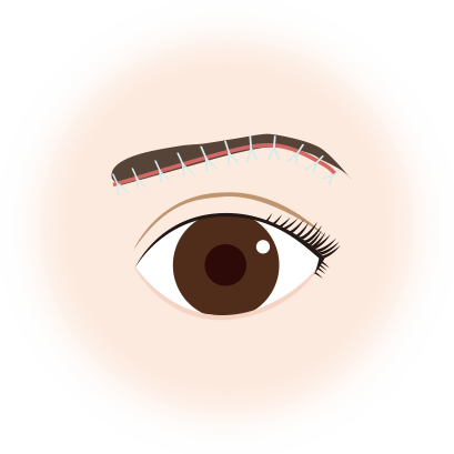 眉下切開 眉下リフト 二重 目もとの整形なら水の森美容外科 眉下切開 眉下リフト 二重 目もとの整形なら水の森美容外科