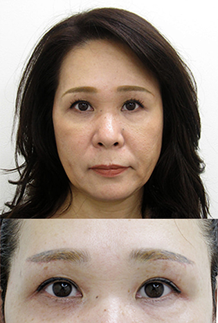 眉下切開 眉下リフト 美容整形 美容外科なら水の森美容外科 公式 総合サイト 眉下切開 眉下リフト 美容整形 美容外科なら水の森美容外科 公式 総合サイト