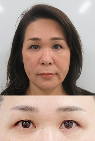 眉下切開 眉下リフト 美容整形 美容外科なら水の森美容外科 公式 総合サイト 眉下切開 眉下リフト 美容整形 美容外科なら水の森美容外科 公式 総合サイト