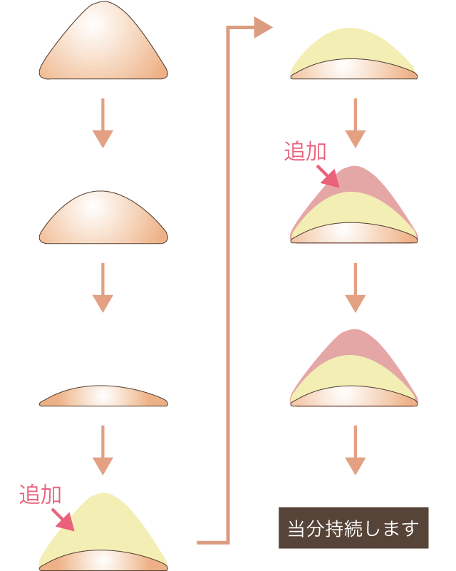 追加注入