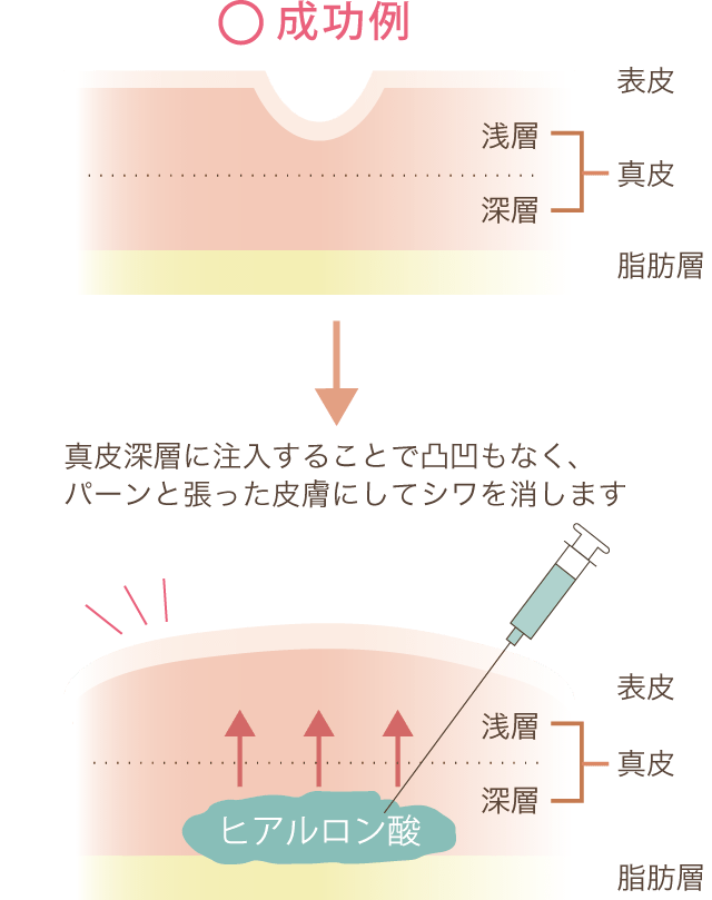 成功例