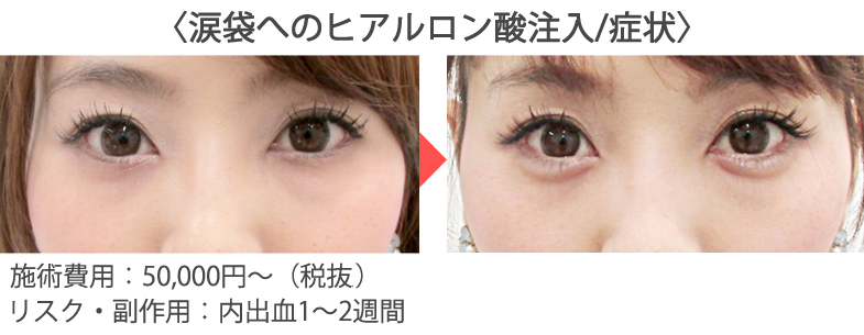 ジュビダームビスタ ボリューマ Xc 美容整形 美容外科なら水の森美容外科 公式 総合サイト