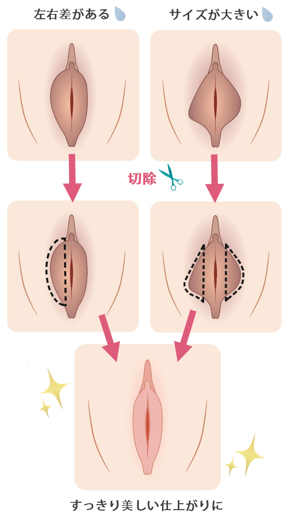 小陰唇縮小 症例