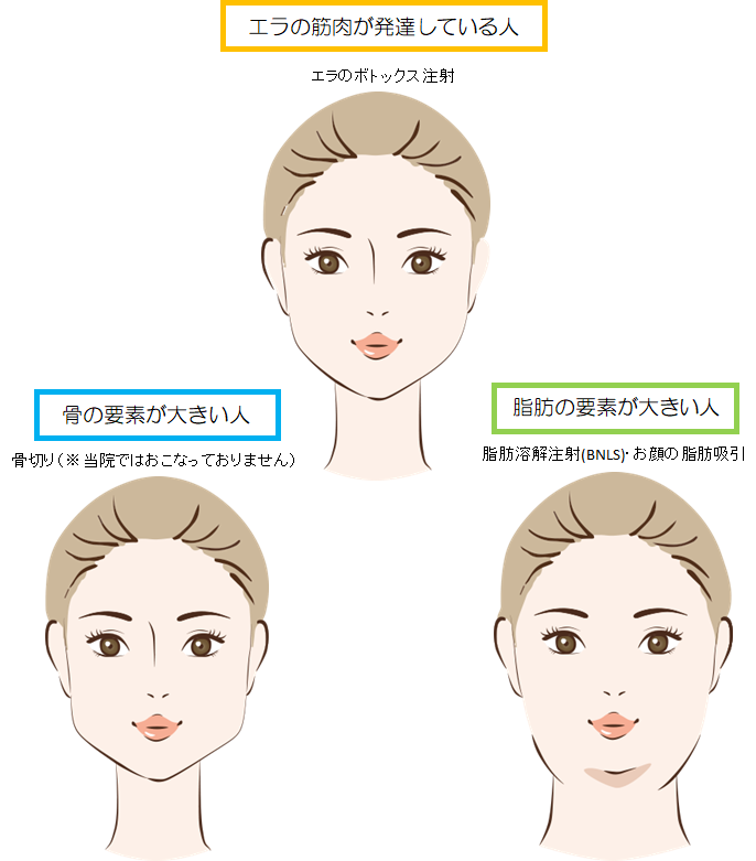 エラのボトックス 注入認定医が在籍 美容整形 美容外科なら水の森美容外科 公式 総合サイト