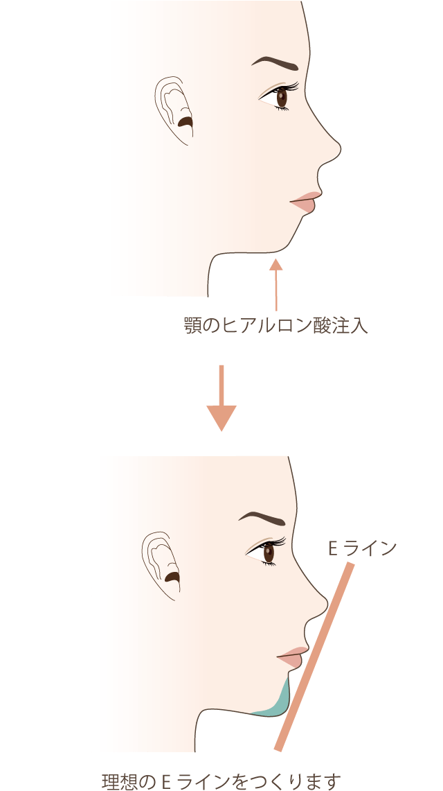 顎にヒアルロン酸を注射し、横顔が整ったEラインになった画像