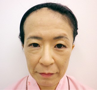 顎のヒアルロン酸注入（正面）の症例写真（術前）
