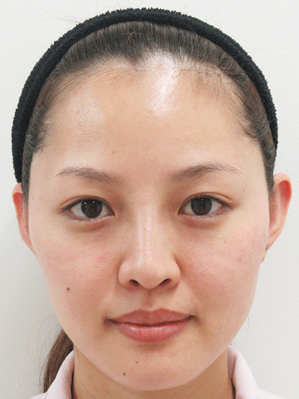 輪郭形成について 美容整形 美容外科なら水の森美容外科 公式 総合サイト