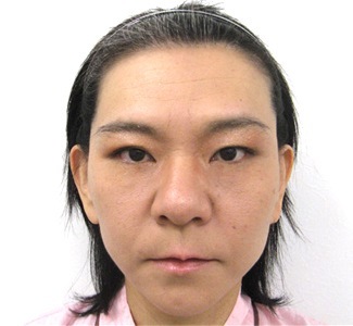 エラのボトックスの症例写真（術後）