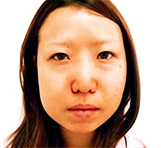 頬・顎脂肪吸引とエラのボトックスの症例写真（術前）