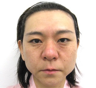 エラのボトックスの症例写真（術前）