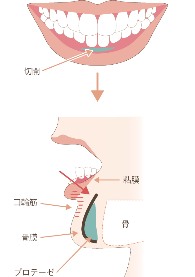 あごプロテーゼ 下顎形成 の整形について 唇 顎 輪郭 整形 美容整形 美容外科なら水の森美容外科 公式 総合サイト