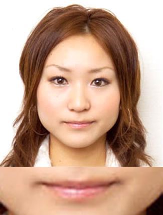 唇のヒアルロン酸注入の症例(術前)