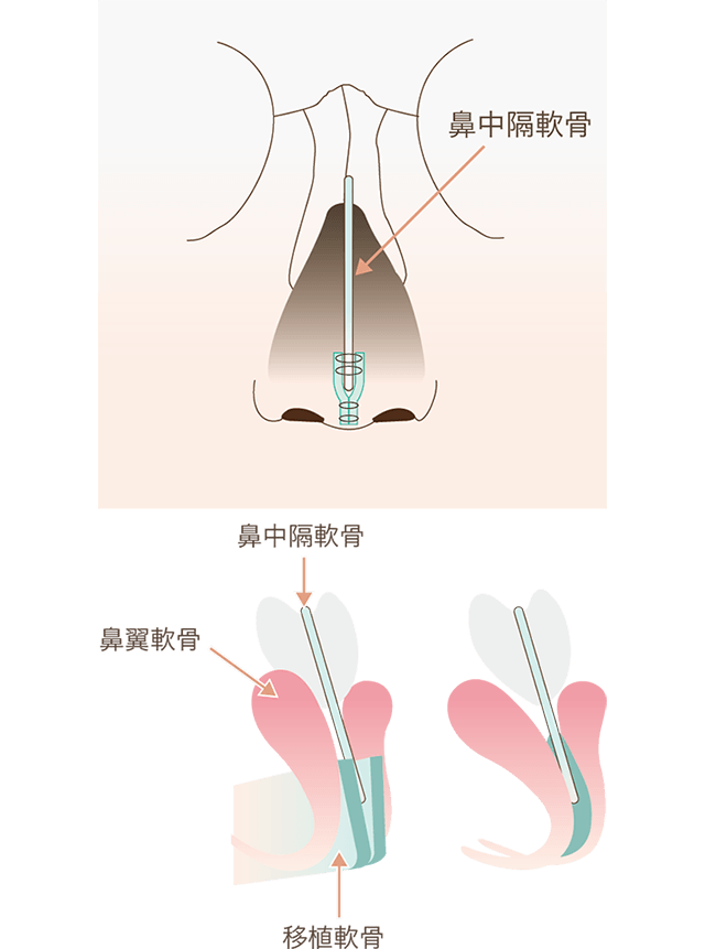 鼻中隔延長術の特徴