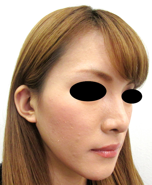 鼻骨骨切り、鼻中隔延長の症例写真（術後）