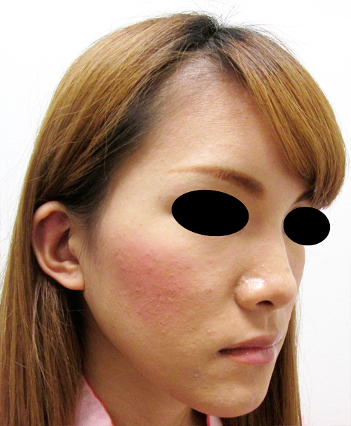 鼻骨骨切り、鼻中隔延長の症例写真（術前）