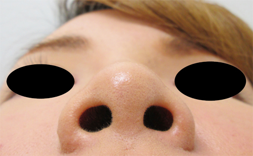 鼻骨骨切り、鼻中隔延長の症例写真（術前）