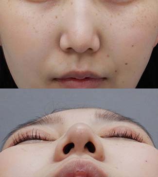 鼻尖縮小（鼻尖形成）の症例写真2（術後）