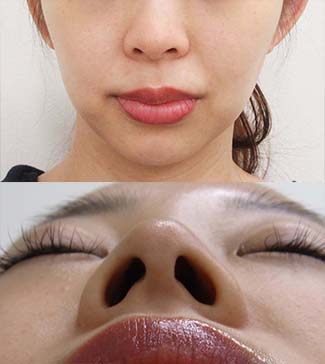 鼻尖縮小の症例写真3（術前）