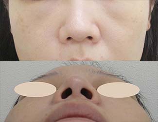 鼻尖縮小（鼻尖形成）の症例写真1（術前）